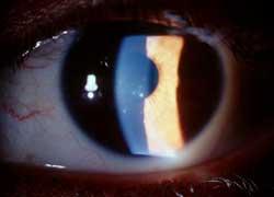 Specific syndromes. Posner-Schlossman. Usually unilateral, rare cases OU. 20-50 yrs old. 40% hypochromia of the iris. Most cases self-limited, 2.