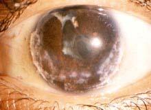 Specific syndromes. JRA. Secondary glaucoma. 14-27%. Pauciarticular. Pupillary block. Progressive closure by PAS.