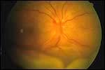Specific syndromes. Sympathetic ophthalmia.