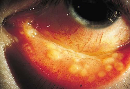Specific syndromes. Glaucoma in sarcoidosis. Pupillary block (posterior synechiae). PAS. Clogging of the TM. Steroid response.