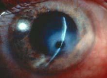 10% of HSV will have secondary glaucoma.