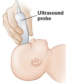 Ultrasound Probe Your baby is at risk for bleeding in the brain because he or she was born early.