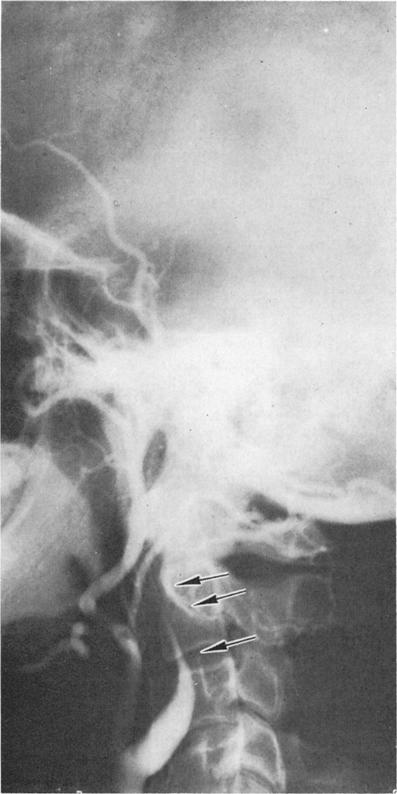 Spasm of extracranial internal carotid FIG. 1. Case 1. Carotid angiogram showing complete occlusion of the left internal carotid 15 days after injury.