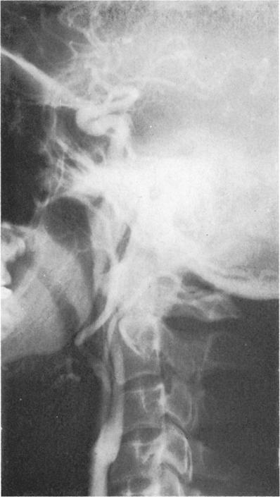 Gurdjian, Audet, Sibayan and Thomas FIG. 3. Case 1. Left carotid angiogram 3 months after the repair of the artery shows normal artery. tive angiogram showed the vessel lumen to be narrowed distauy.