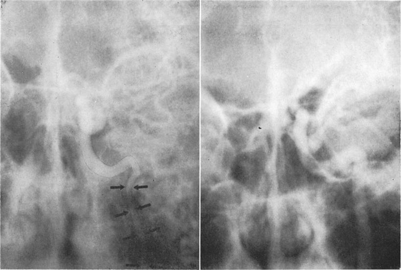 FI6. 4. Case 2. Left: Left carotid angiogram, anteroposterior view, obtained 5 days after water skiing accident.