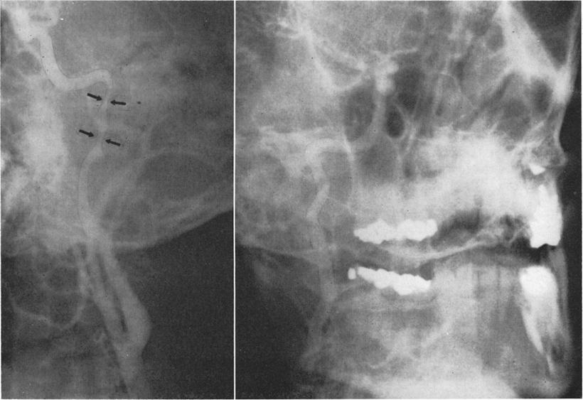 The carotid spasm has disappeared. FI6. 5. Case 2. Left: Left carotid angiogram, oblique view, obtained 5 days after the water skiing accident.