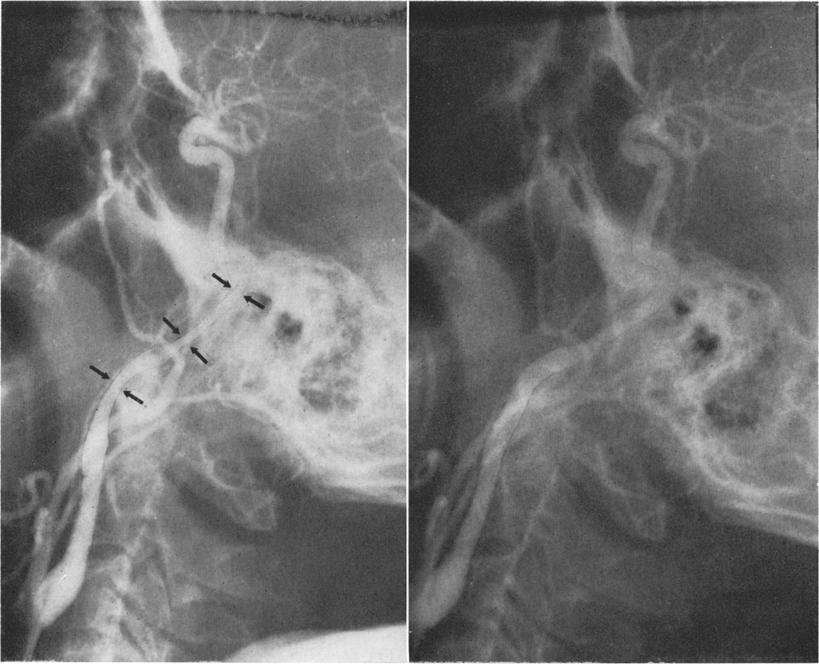 Gurdjian, Audet, Sibayan and Thomas FIG. 6. Case 2. Left: Left carotid angiogram, lateral view, obtained 5 days after the water skiing accident.