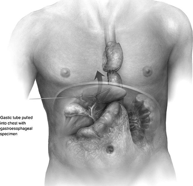 1772 J Gastrointest Surg (2012) 16:1768 1774 Fig. 3 Advancement of the specimen and gastric conduit into the chest.