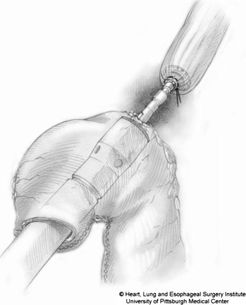 To this point, many surgeons have attempted minimally invasive intrathoracic anastomosis.