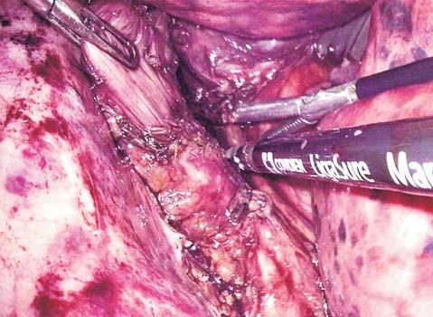 Recent Advances in Minimally Invasive Esophagectomy Figure 3. Dissection of the esophagus (collection of Center of Excellence in Esophageal Surgery, Sf. Maria Clinical Hospital, Bucharest) Figure 4.