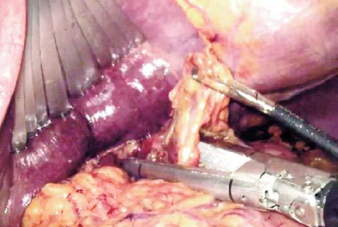 The EndoFan is inserted into the subxiphoid trocar and helps to retract the left hepatic lobe from the work field and exposure of the esophageal-gastric junction.