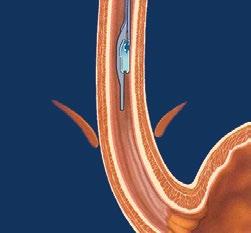 HOW IT WORKS The test involves a miniature ph capsule, which is approximately the size of a gel cap. The capsule is temporarily attached to the wall of your esophagus.