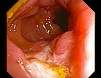 discrete, fibrin-covered defect of the mucosa (>5mm but less< 2cm