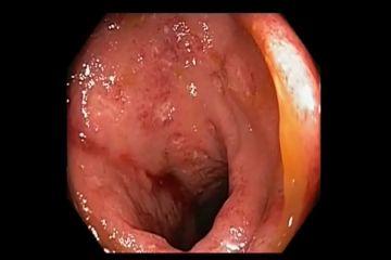 SES\CD:)Example) Aphthous ulcers (0.1-0.5 cm) are present in the ileum Score = 1.0 for the ileum Extent of ulcerated surface is 10-30% in the ileum Score = 2.