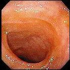 or lesions confined to the ileocolonic