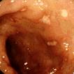 large ulcers, normal mucosa in between