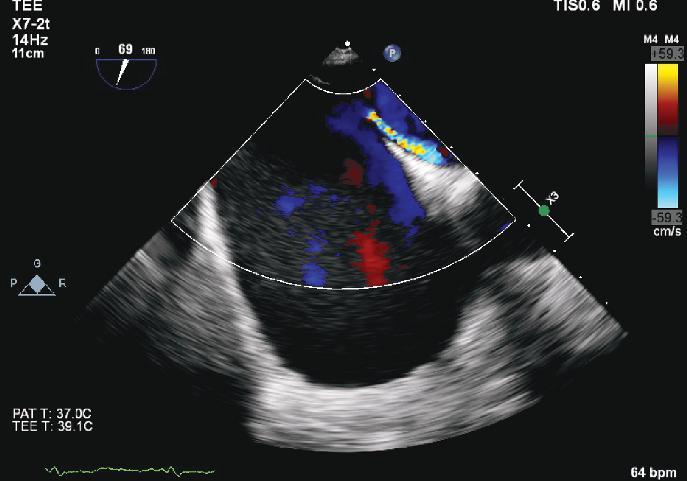 Figure 3. Transesophageal echocardiogram showing a dilated right atrium and patent foramen ovale with continuous shunting.