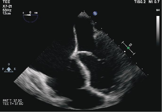 Cardiac computed tomography (CT; Figures 5 and 6) was ordered to evaluate for anomalous pulmonary veins, and revealed subtle fat attenuation in the right ventricle; however, motion degradation was
