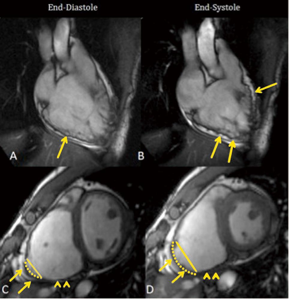 Arrhythmogenic RV Dysplasia Figure 5. Cardiac MRI of a patient with ARVC.