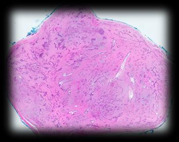Fibroepithelial Tumors of the Breast Distinct from breast
