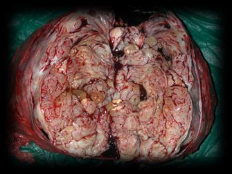 malignant phyllodes tumors Phyllodes tumors are rare in