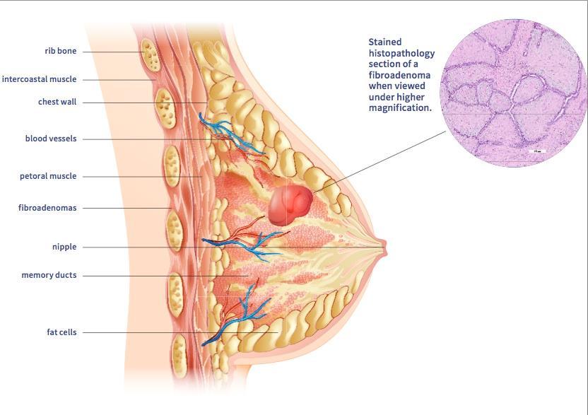 Breast Fibroademona ( Breast Lumps ) Most common benign breast tumor in young women 1 in 10 women, aka