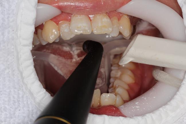 lingual tooth surfaces: 1 sec.