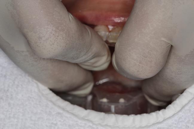 brush to apply resin on prepared tooth surfaces; and, assistant use other