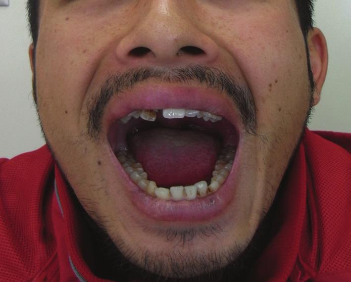 4 Plastic Surgery International Figure 4: Image shows good mouth opening with a slight deviation of the jaw and good occlusion relationship. 6.