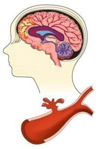 There are two types of hemorrhagic stroke: Intracerebral hemorrhage: Is the most common type of hemorrhagic stroke.