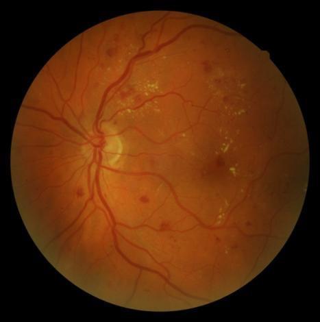 Diabetic retinopathy A leading cause of visual loss globally Patients with diabetes are 25 times more