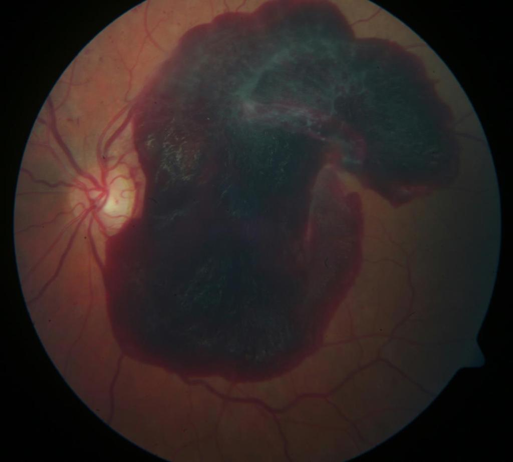 PDR/VH PM 53yo WF Vision CF@6in PDR,