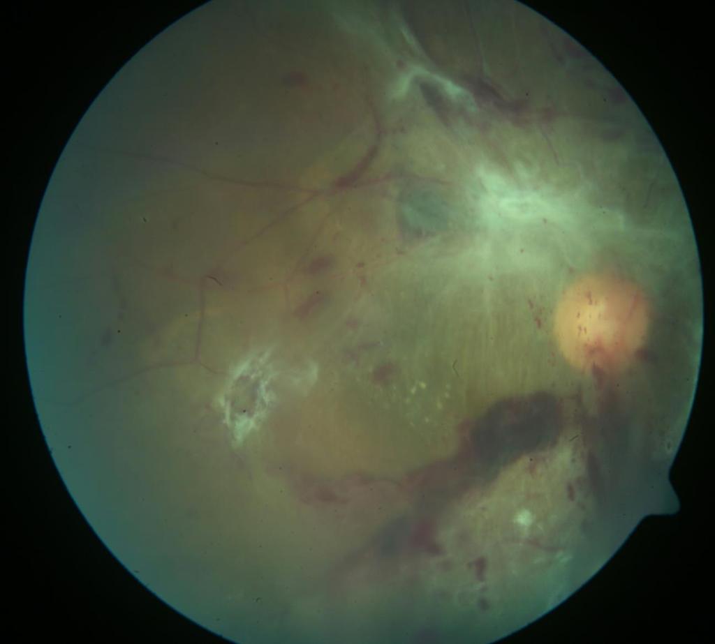 PDR, proliferative diabetic retinopathy; VH, Vitreous hemorrhage; TRD,