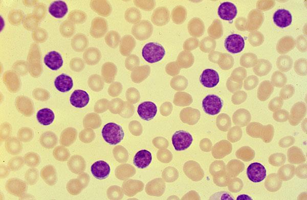 Diagnosis: CLL Differential blood