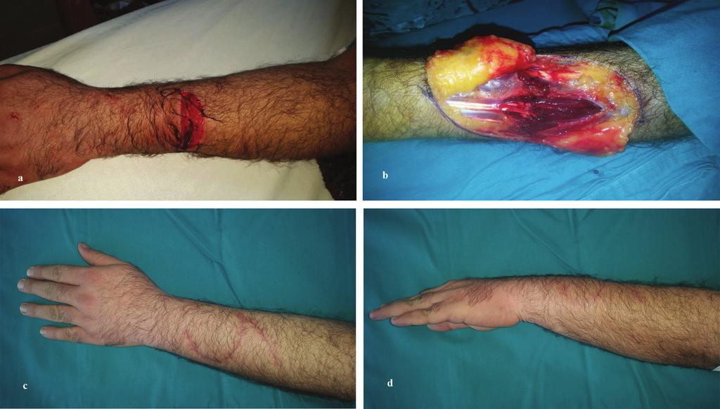 164 Tendon Surgery and Rehabilitation Figs. 5. a: A 27 years old male patient with multiple extensor tendon injury at the level of Forearm. b: is intraoperative.