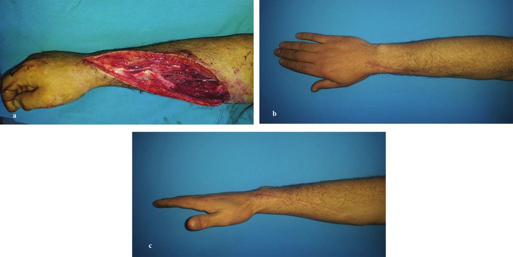a: A 37 years old male patient with both flexor and extensor tendon and superficial radial nerve injuries. b and c: are postoperative 14 months views, full extension could be seen in these figures.
