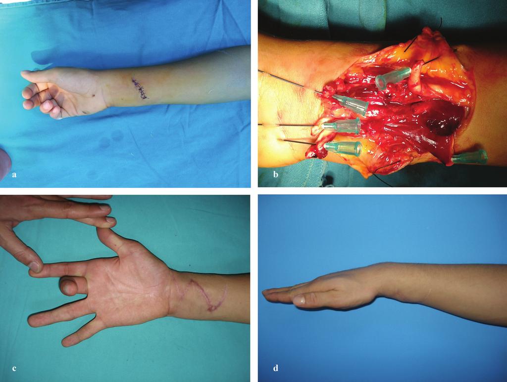 Sari 165 Figs. 7. a: Preoperative picture of 20 years old male patient with 1st, 2nd, and 3rd flexor tendons, palmaris longus, flexor carpi radialis, partial median nerve injuries.