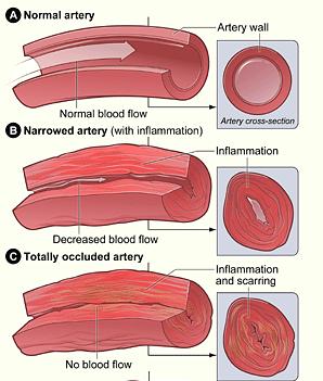 Systemic Vasculitis Inflammation of blood vessels which leads to tissue necrosis Blood vessels affected include arteries, veins, and capillaries Common