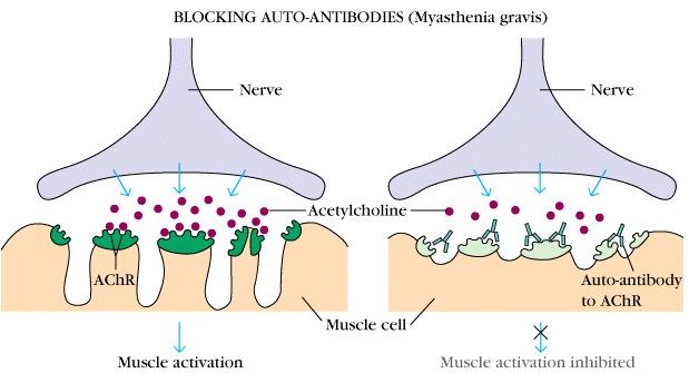 Myasthenia Gravis The immune system produces antibodies that block or destroy many of your muscles' receptor sites for a