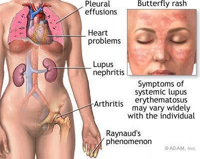 Systemic Lupus Erythematosus (SLE) Lupus is a chronic inflammatory, rheumatologic disease that occurs when your body's immune system attacks your own