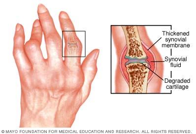 Rheumatoid Arthritis Rheumatoid arthritis affects the lining of your joints, causing a painful swelling that can eventually result in bone erosion and joint deformity.