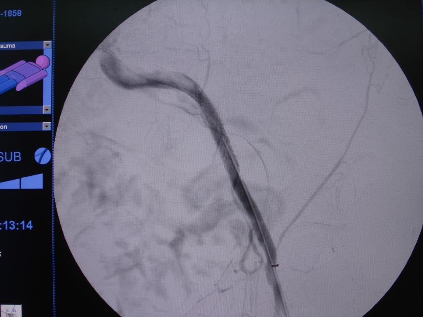 Iliac-femoral Artery : Angioplasty