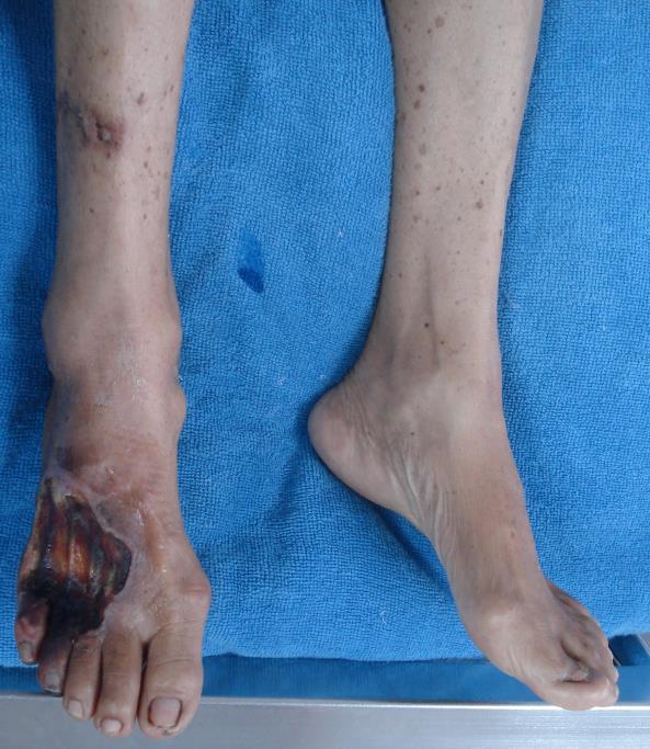 Ischemic ulcer at dorsum of R foot & rest pain
