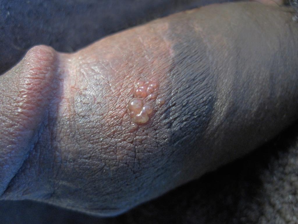 Figure 9 Recurrent Genital HSV Lesions Vesicle Phase This patient with recurrent HSV has a crop of lesions at the