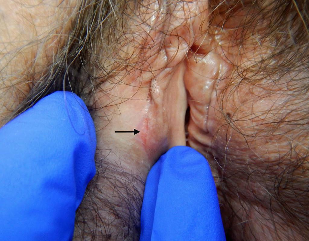 Figure 13 Recurrent Genital HSV with Subtle Lesion This photograph shows subtle HSV lesion that lesions may develop as