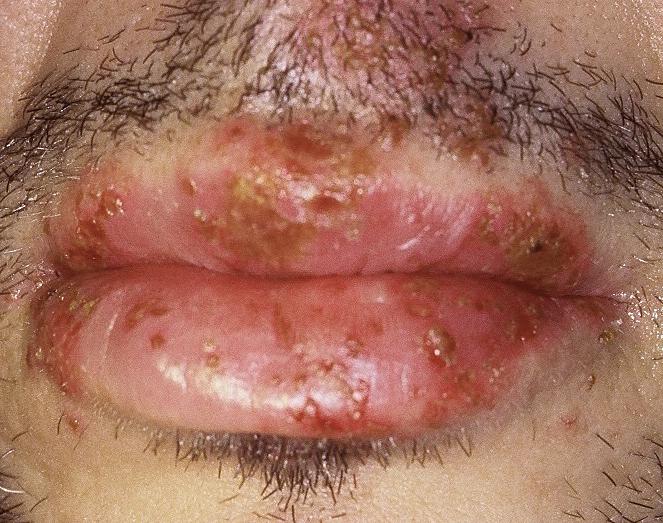 Figure 16 Primary Oral HSV Infection This photograph shows characteristic finds with primary oral HSV