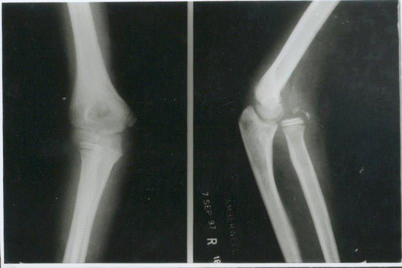 Figure 2: Radiograph of the right elbow 45 days after