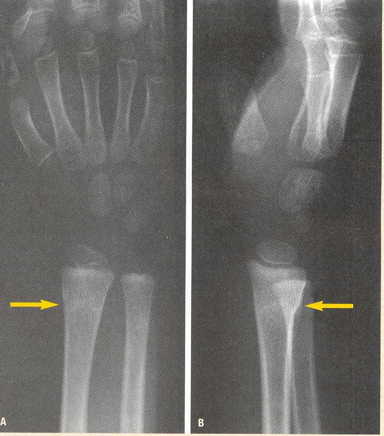 SHAFT INJURIES In children a strong, thick, and very elastic periosteum acts like a splint around broken bone. Immature bone has the ability to bow rather than break in response to force.
