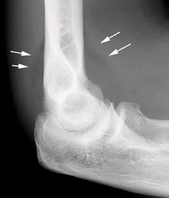 Fat pad sign: Fat is normally present within the joint capsule of the elbow.