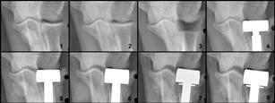 Radial head arthroplasty JHS, 2006 Technical Pearls Resected radial head is the best template for